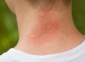 Piqures de punaises de lit, les dangers des allergies