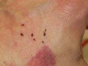 Piqures de punaises de lit et maladie de la peau, qu’en est-il vraiment ?