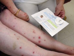 Vivre avec les punaises de lit : un confinement particulièrement difficile pour les habitants de Marseille