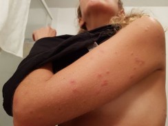 Toulouse : elle réclame un dédommagement de plus de 6 000 euros après avoir été piquée par des punaises de lit dans un hôtel