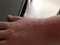 Rennes : une famille vit un véritable cauchemar à cause des punaises de lit